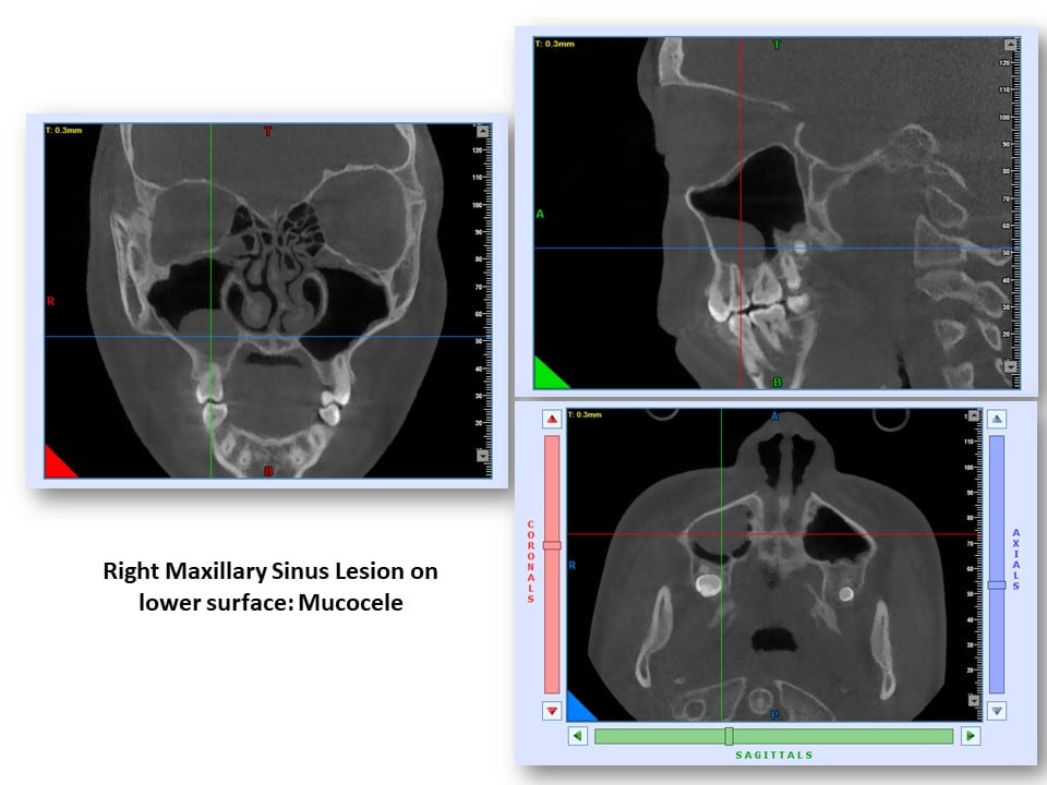 Root Canal Diagnostics Using 3D Imaging •