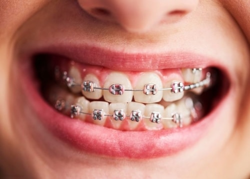 Traditional Braces for Your Teeth