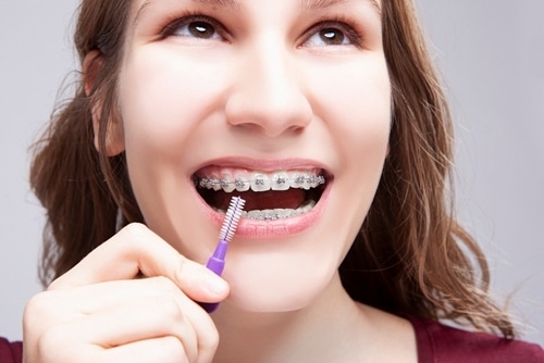 Exploring the Best Tools to Use at Home to Clean Your Teeth in Braces