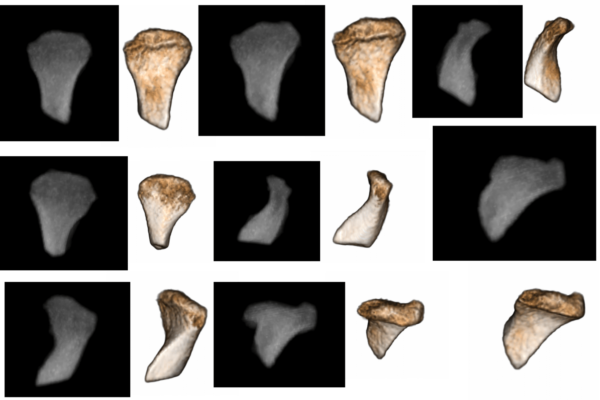Reconstructed 3-D images of the degenerated jaw joint