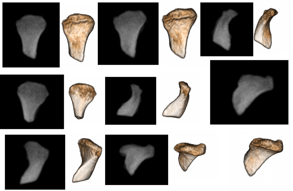 Reconstructed 3-D images of the degenerated jaw joint