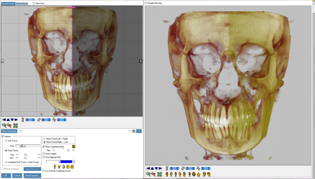 Symmetry Assessment of Facial Skeleton