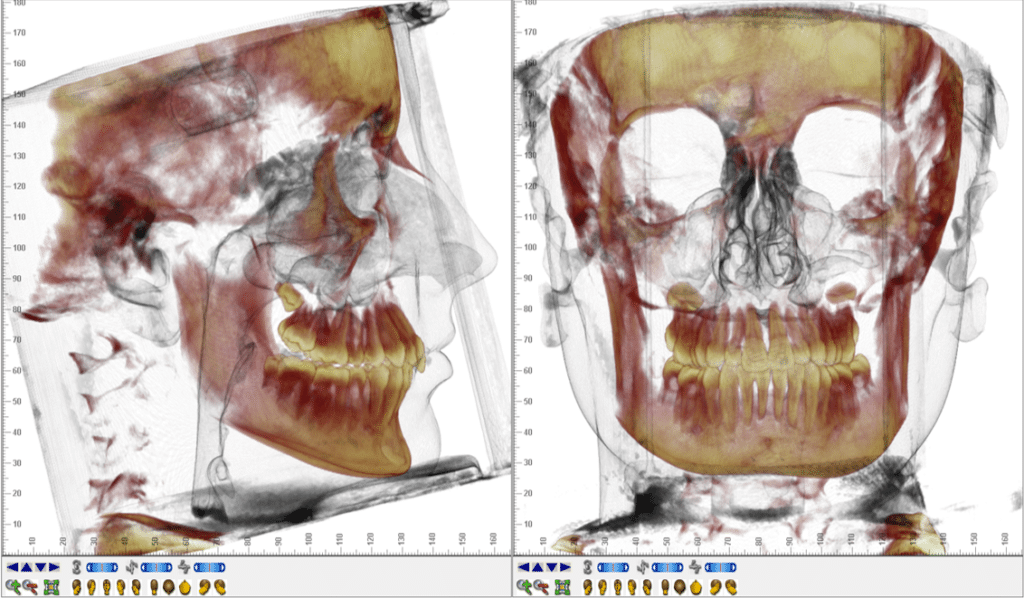 Full view scan of the facial skeleton with soft tissue rendering including airway