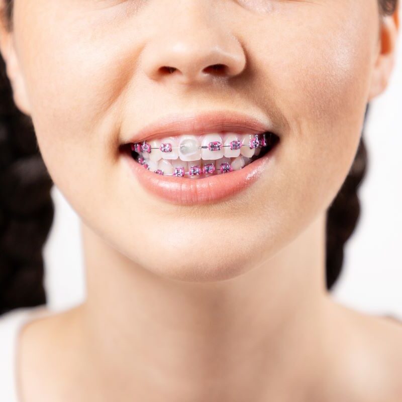 Orthodontic Emergency Care Braces Close Up in San Francisco, California