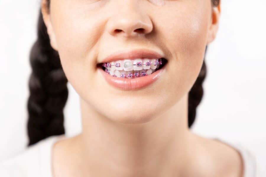 Orthodontic Emergency Care Braces Close Up in San Francisco, California