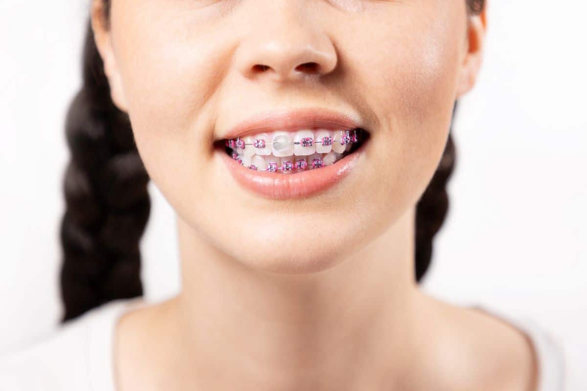 Orthodontic Emergency Care at OPDSF Orthodontics